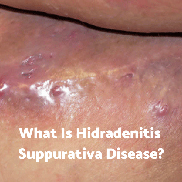 What Is Hidradenitis Suppurativa Disease?